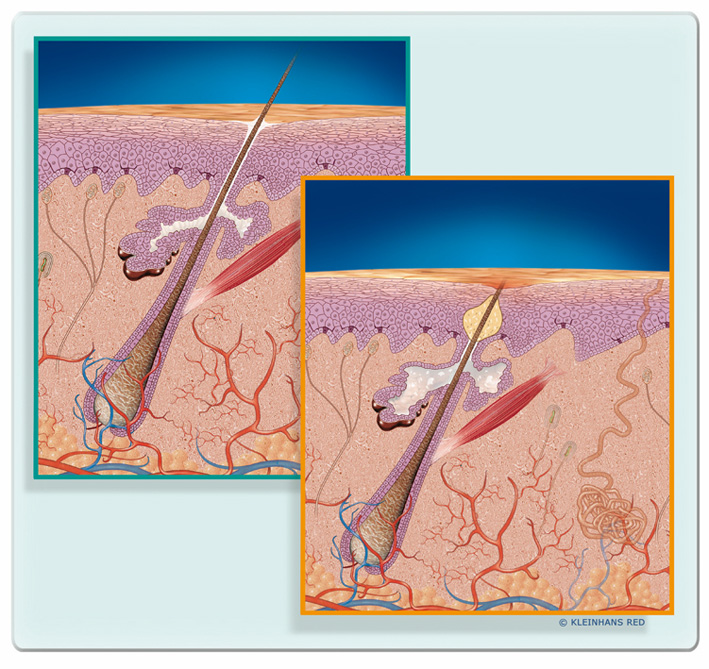 scf34_impure_skin big scf34_impure_skin big